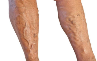 Лечение варикоза вен на ногах